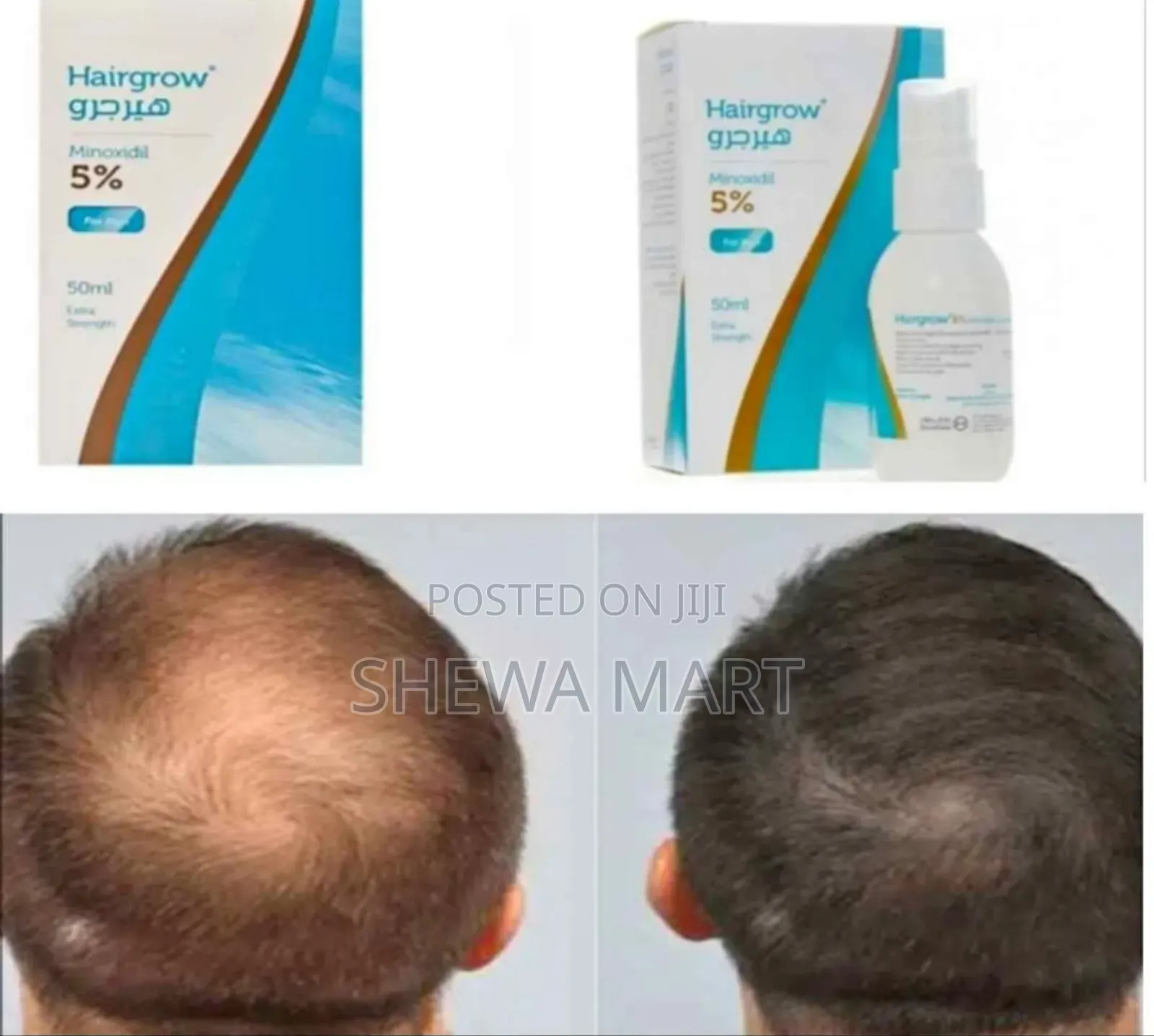 Hairgrow Minoxidil 5% ጥራቱን የጠበቀ የፀጉር ማሳደጊያ አቀረብንልዎ!! Minoxidil በ