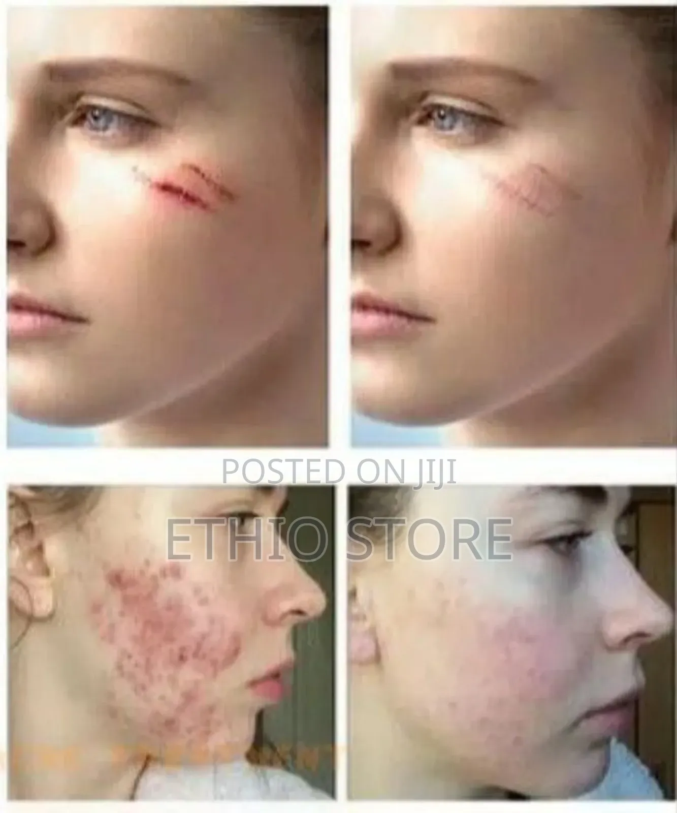 Jaysuing Silicone Scar Gel