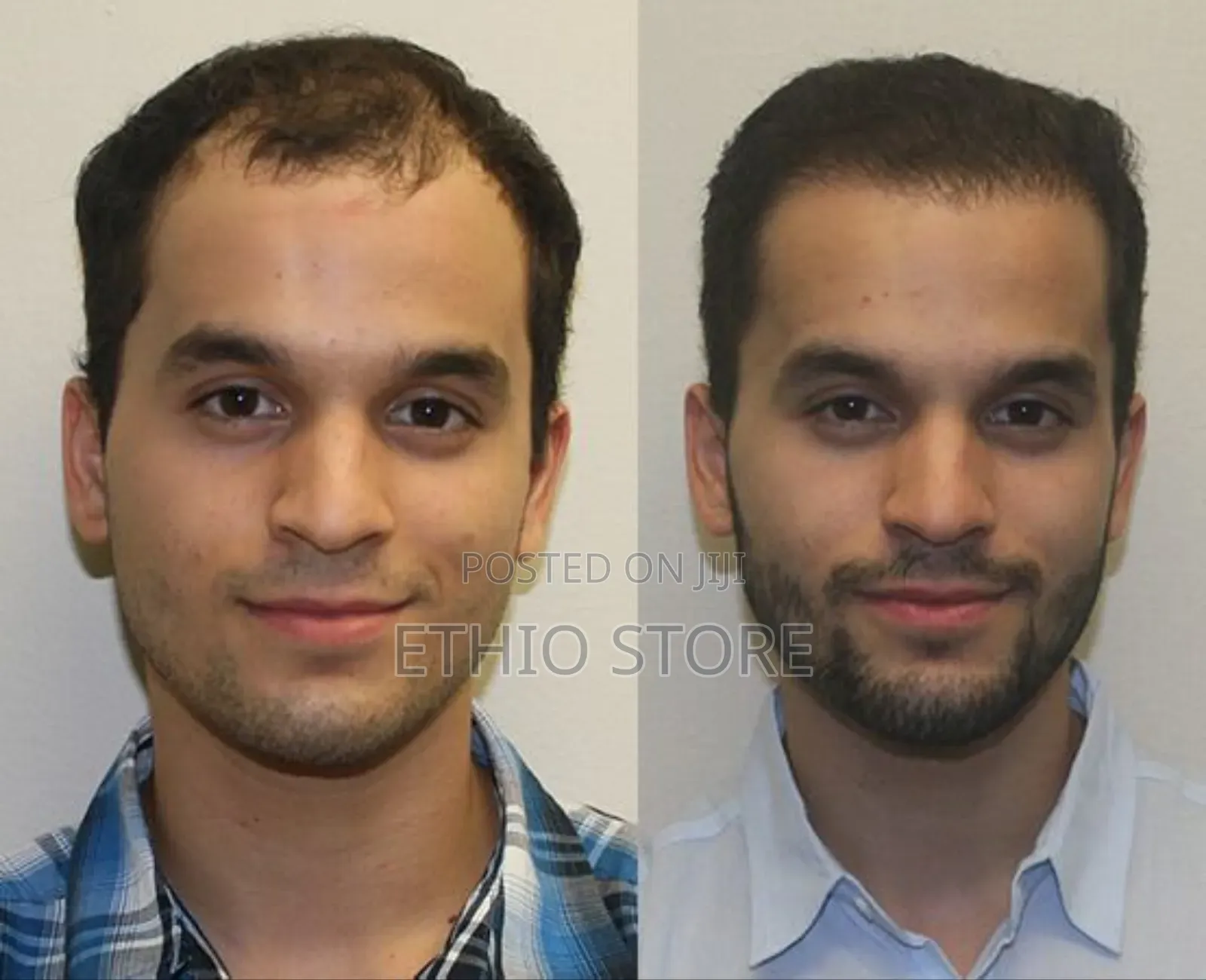 Men’S Rogaine 5% Minoxidil Topical Foam