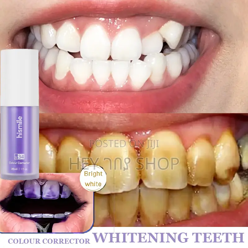 ወይንጠጁ የጥርስ ማንጫ (Purple Teeth Repair)