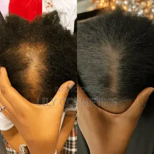 Kirkland Minoxidil 5% Solution