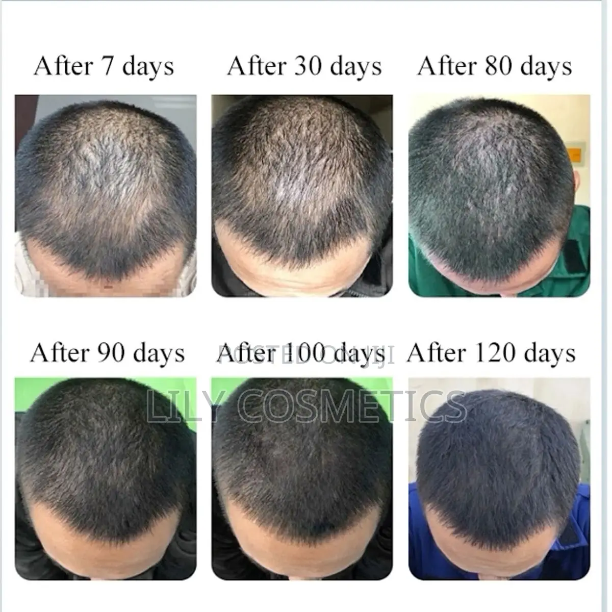 Kirkland Minoxidil 5% Solution