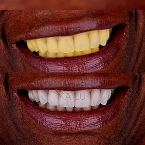 Lanbena Teeth Whitening Mousse