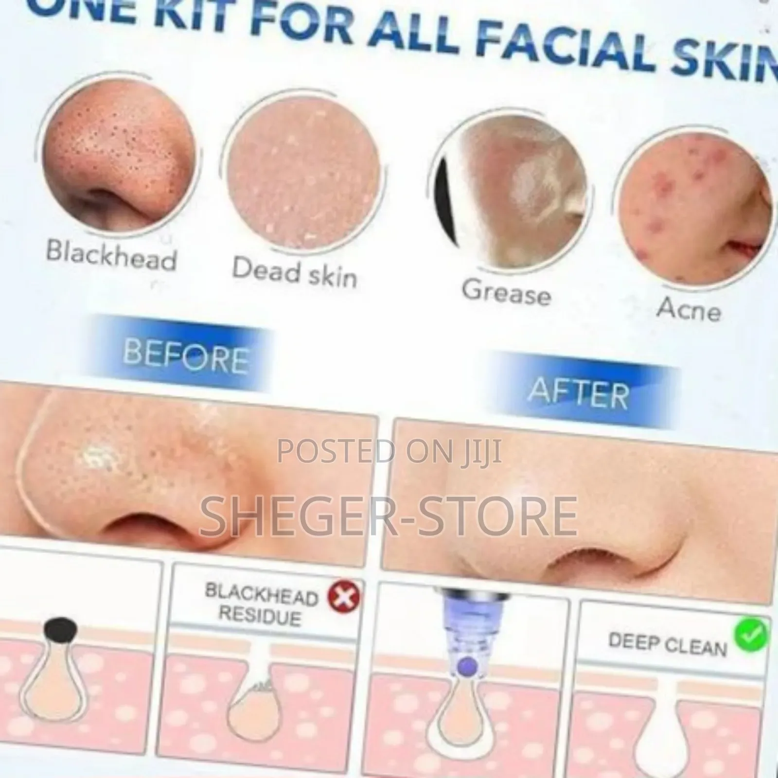 Orginal Facial Vacuum Blackhead Acne Pore Skin Cleaner