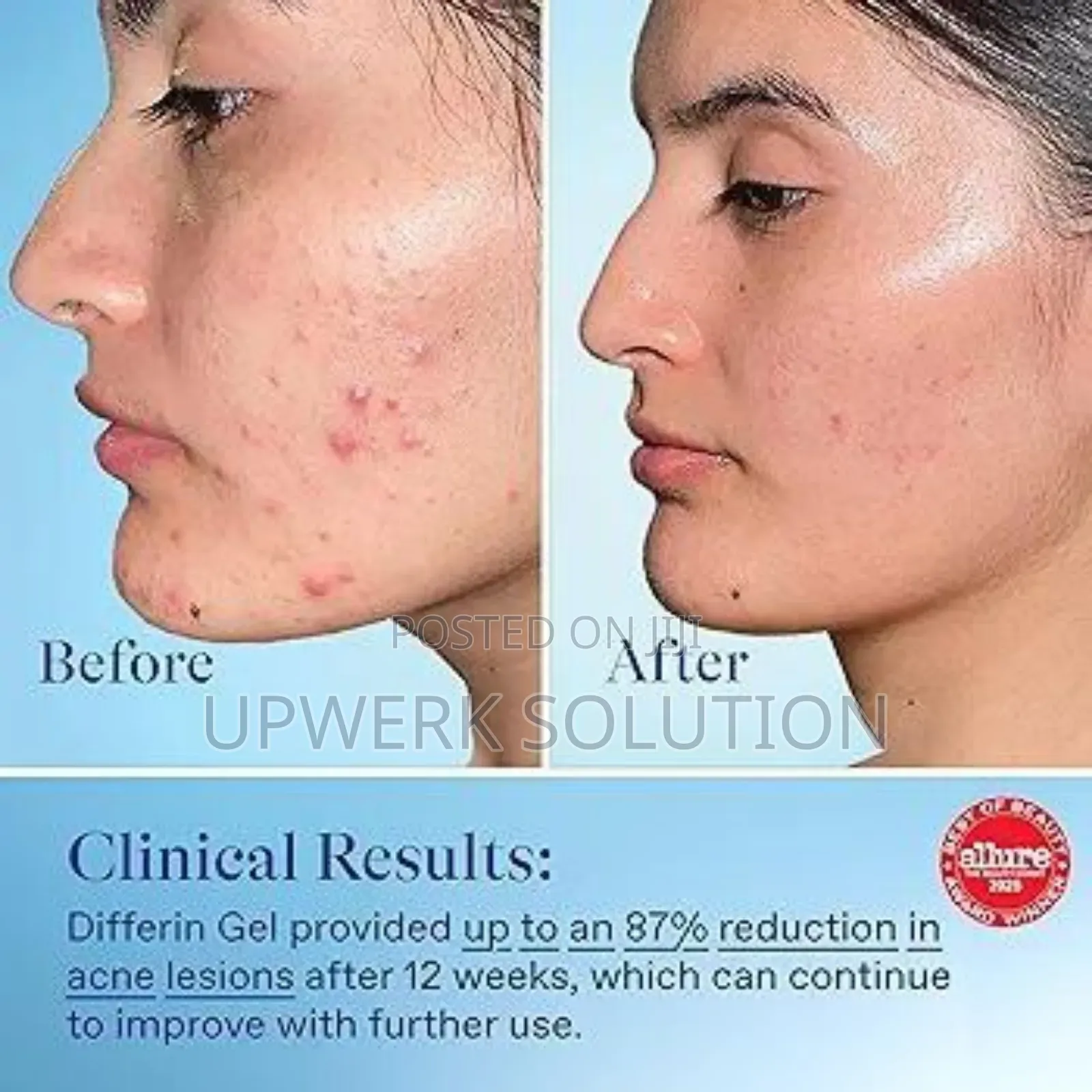  Differin Acne Treatment Gel (0.1% Adapalene)  45g