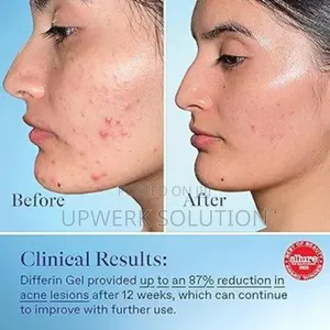  Differin Acne Treatment Gel (0.1% Adapalene)  45g