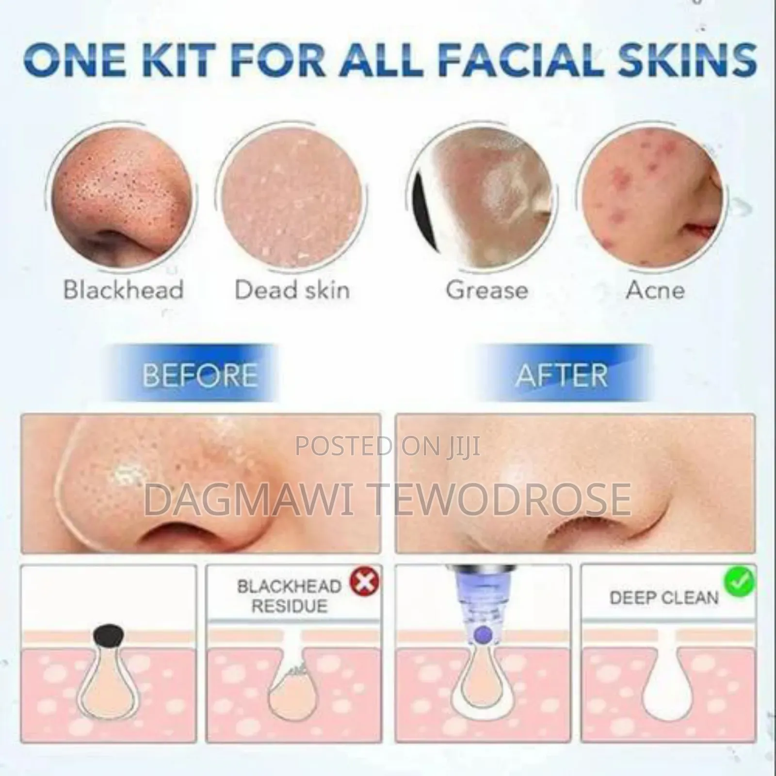 Facial Vacuum Blackhead Acne Pore Skin Cleaner
