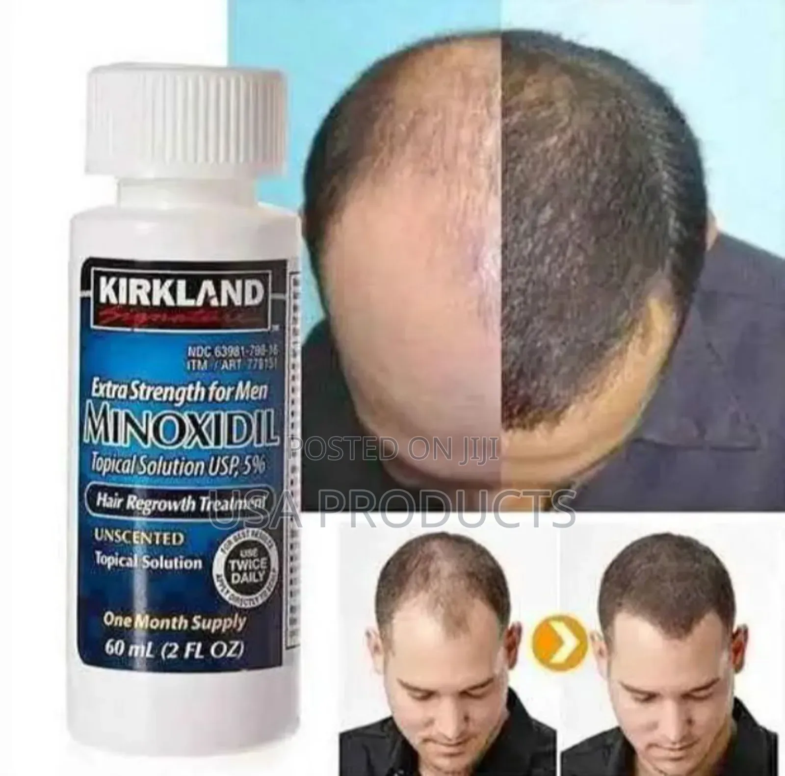 Minoxidil Kirkland Usa and Israel የሚኖክስዲል