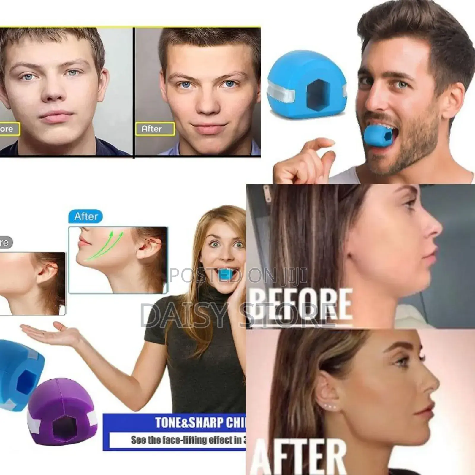 Jaw Liner / የተንጠለጠለ የአገጭ ስብ ማጥፊያ