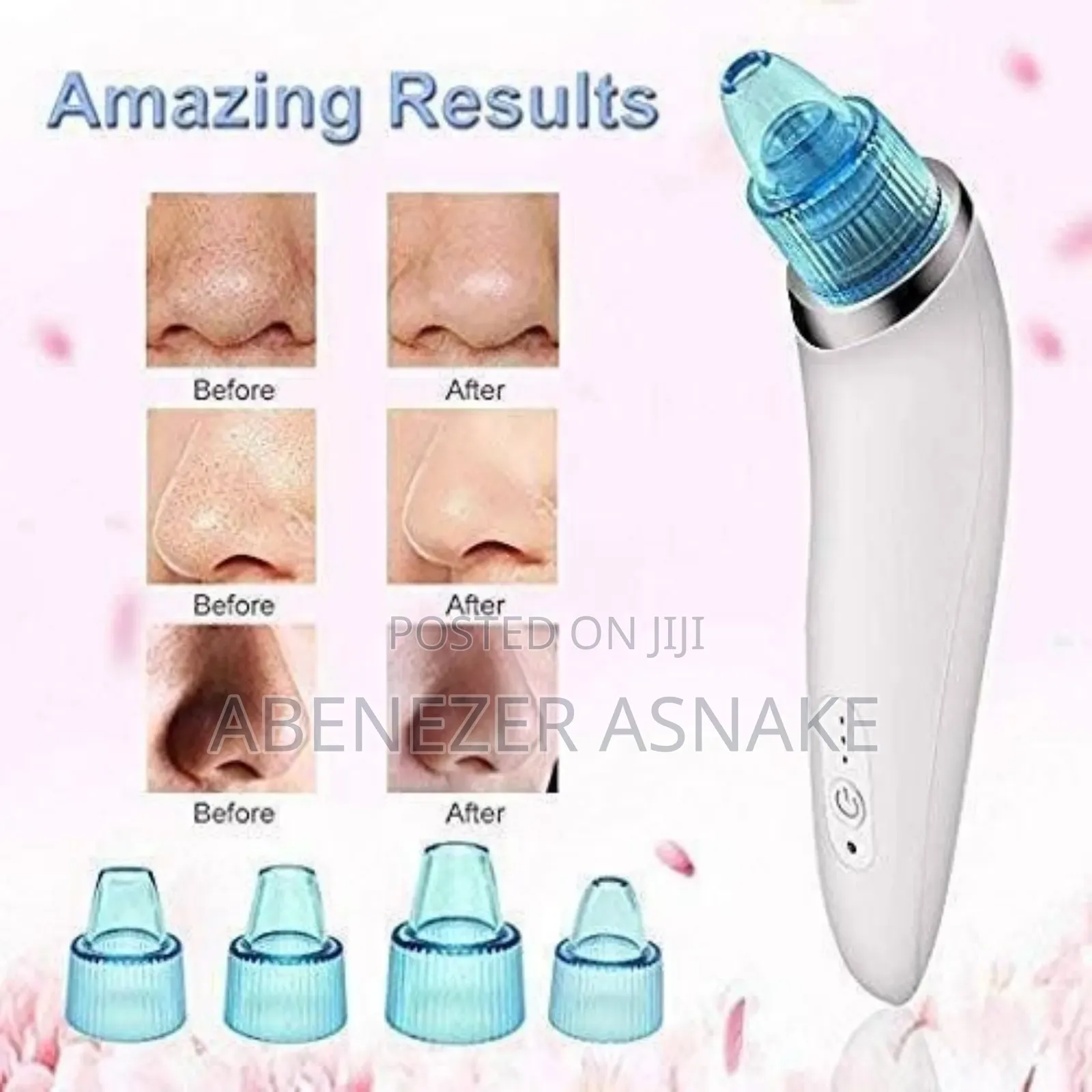 Vacuum Blackhead Remover