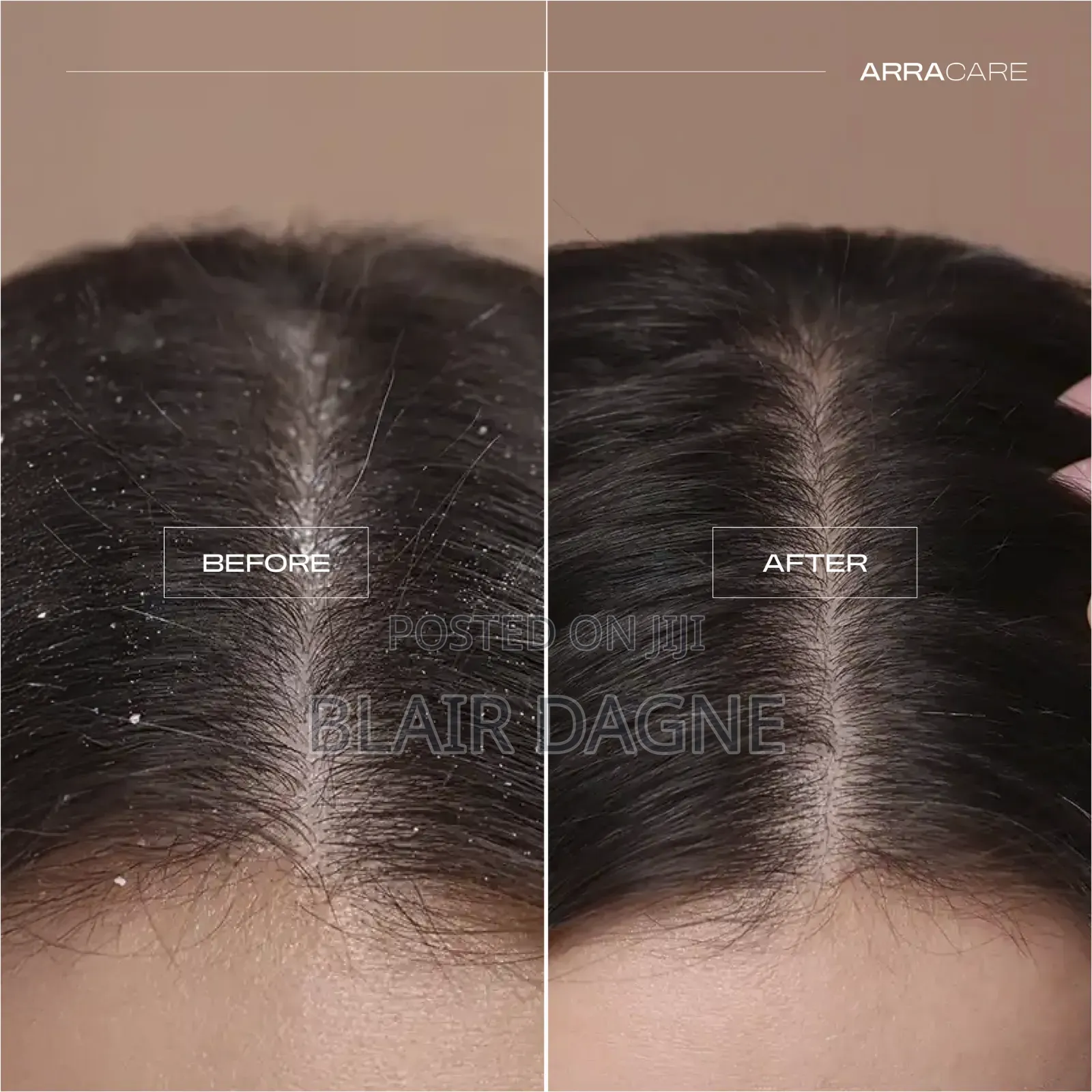 Nizoral Anti-Dandruff Shampoo