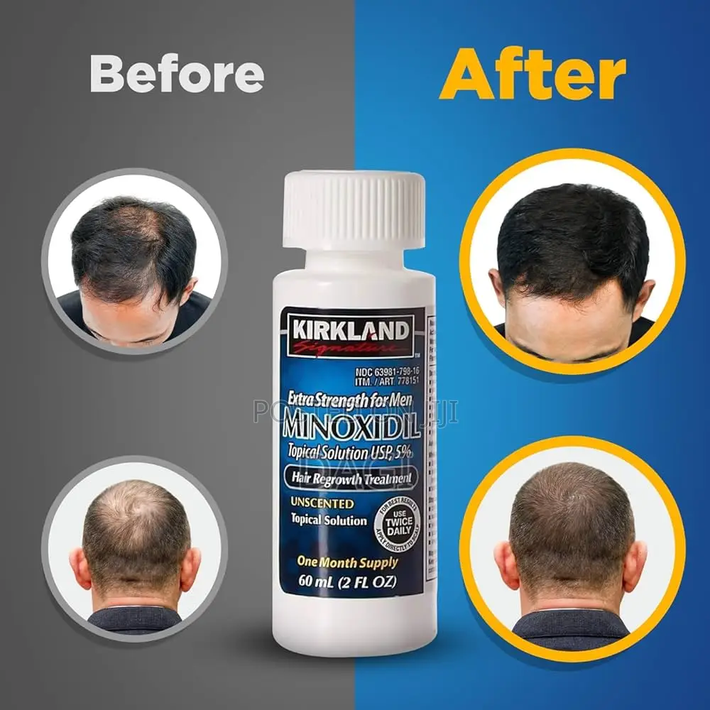 5% Kirkland Minoxidil for Hairloss