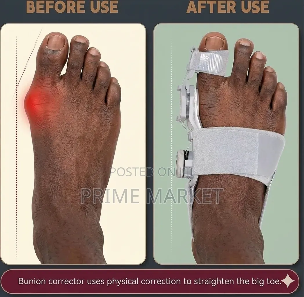 Adjustable Bunion Corrector Very Effective | Comfortable Pain Free