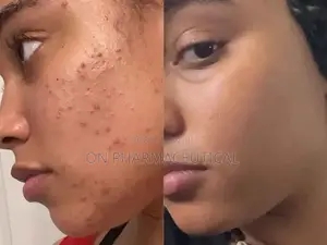 Tretinoin Cream 0.05%