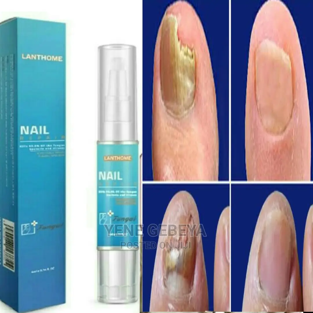 የተበላሹ ጥፍሮች ካለዎት እኛ ጋ ይደውሉ