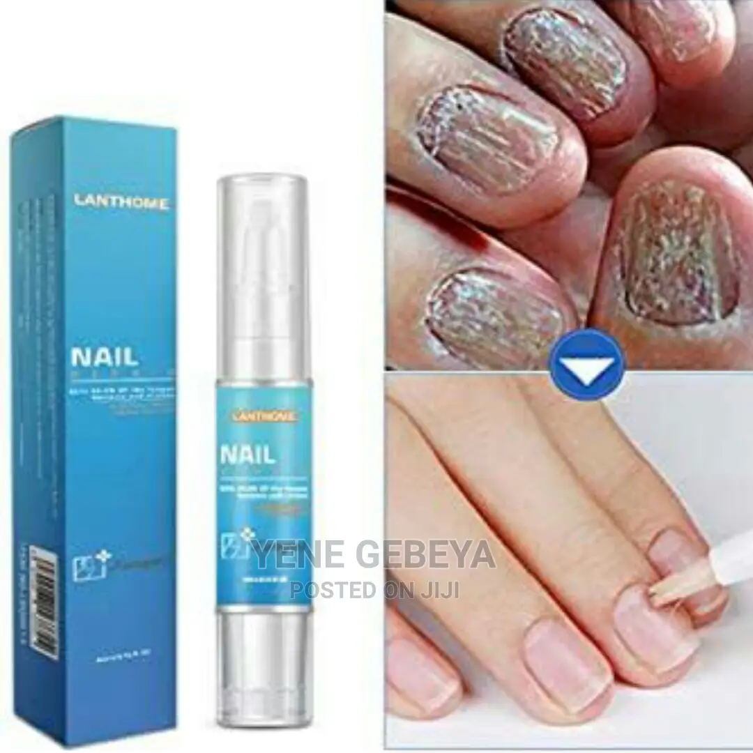 የተበላሹ ጥፍሮችን ማስተካከያ