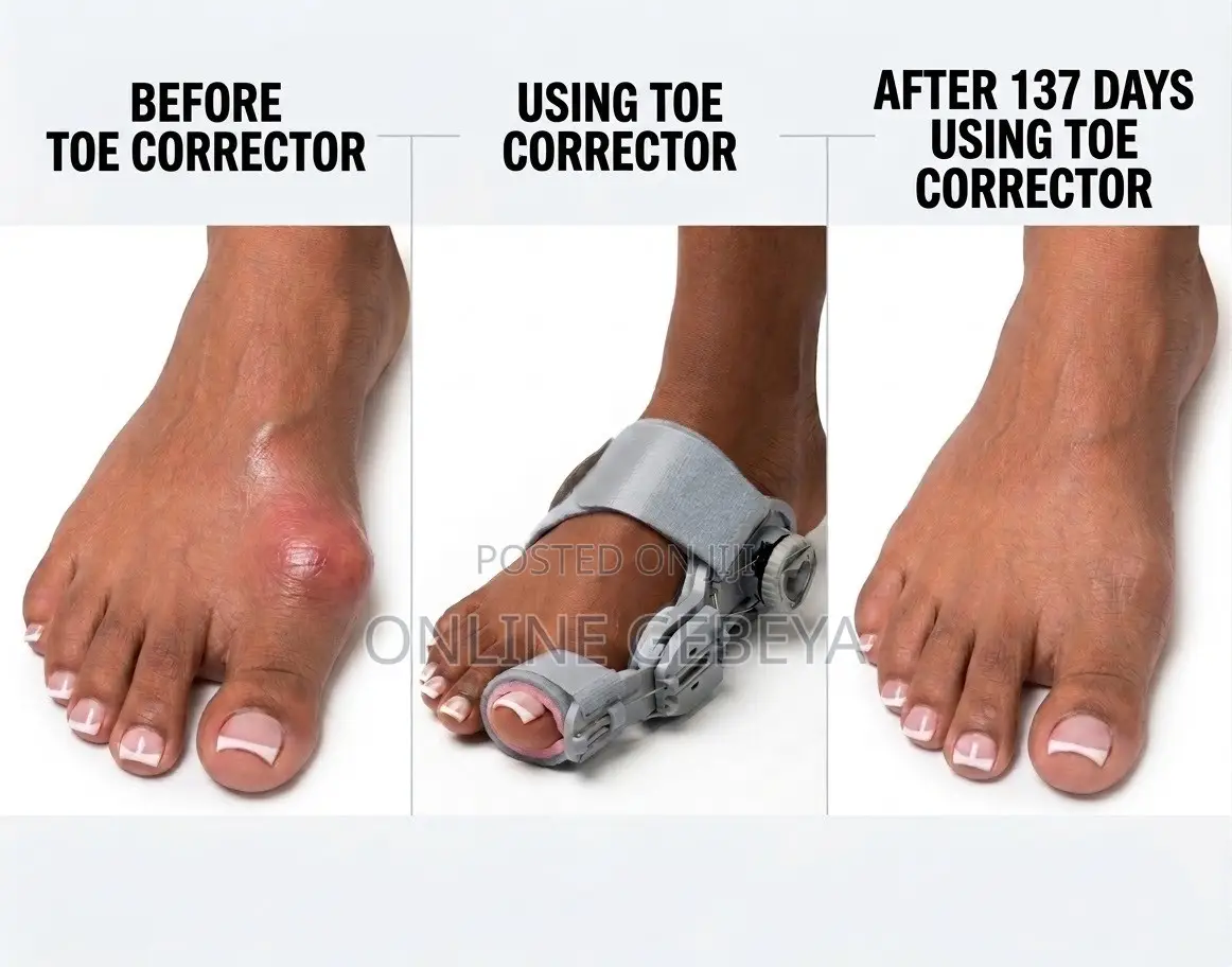 Buion Corrector