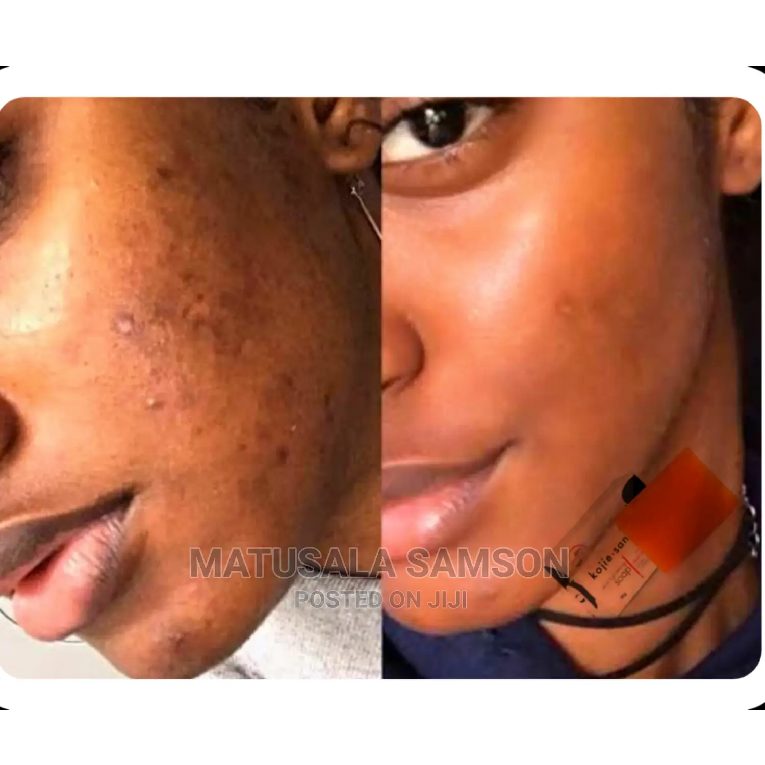 Kojic San Soap