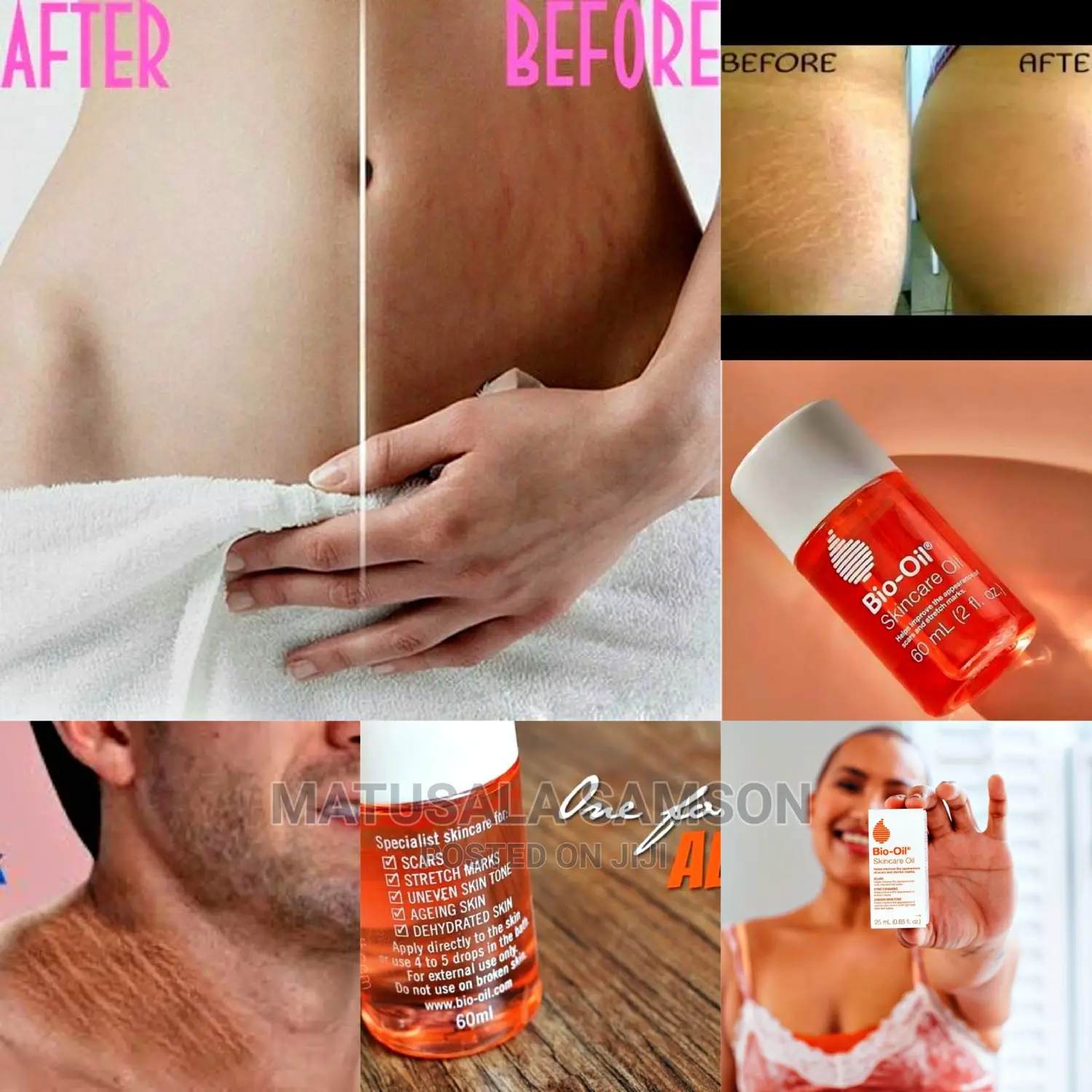 Bio Oil Skin Care Oil Strech Marks