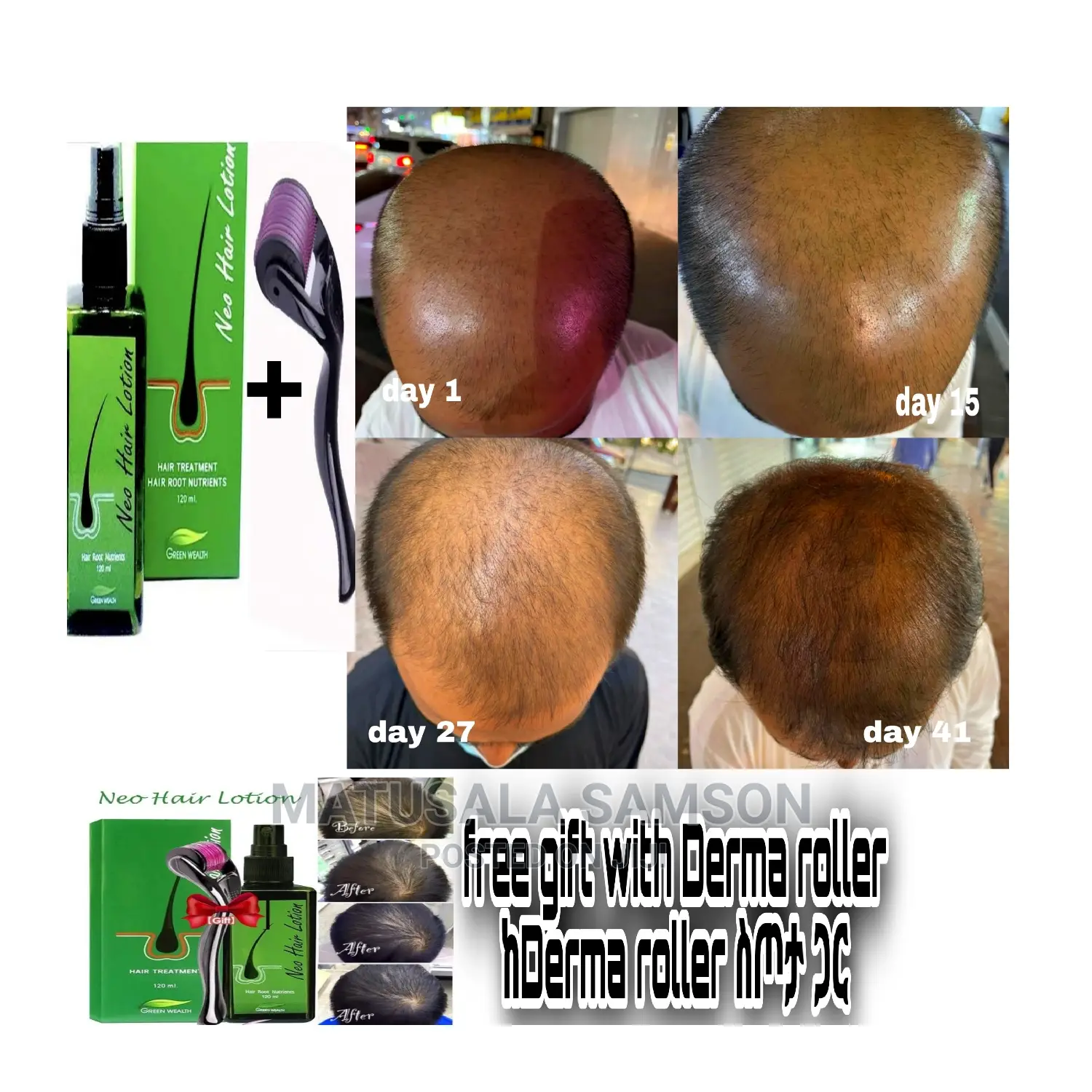 Neo Hair Lotion +Derma Roller Gift