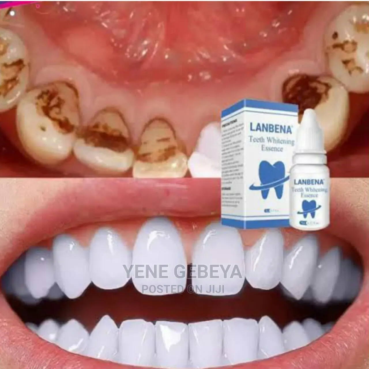 የበለዘ፣ የጠቆረ ፣በፍሎራይድ የተጠቃ ጥርስን የሚያነጣ