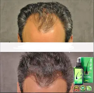 ኒዮ ፀጉር ሎሽን 100% ኦሪጅናል ከነጻ የማድረስ አገልግሎት ጋር እና ደርማ ሮለር