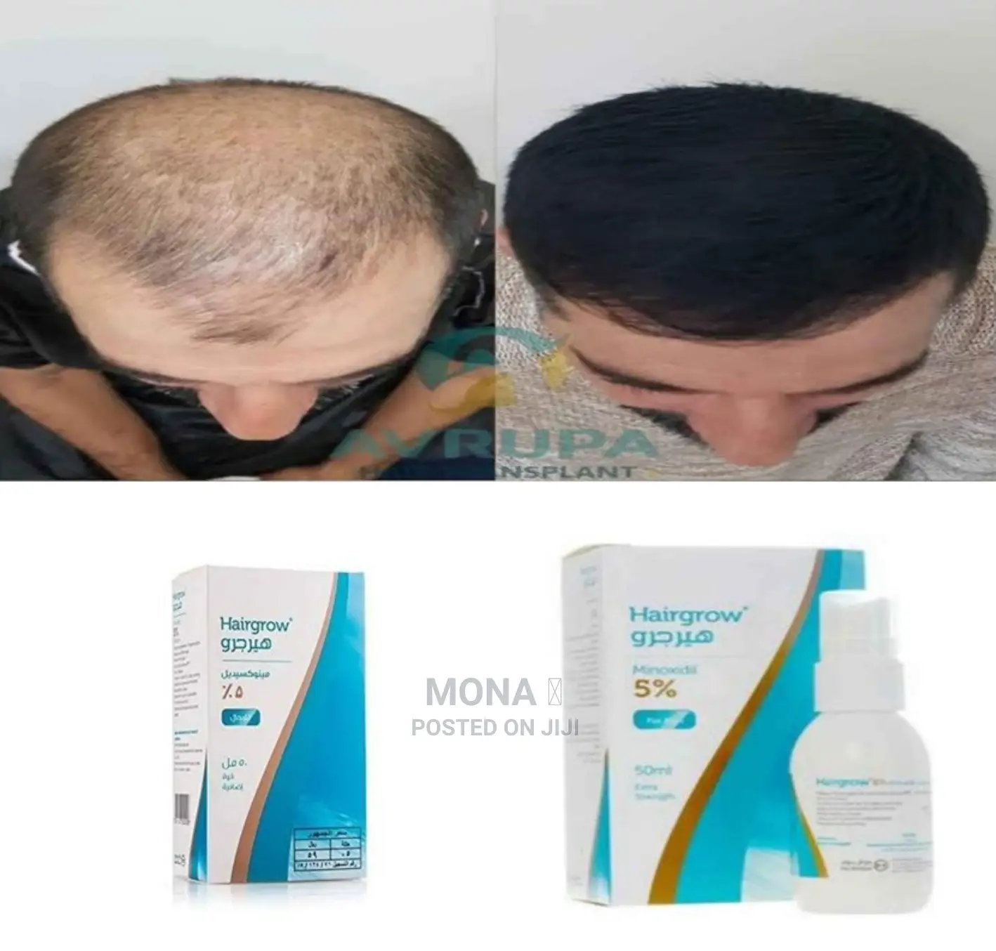 ጺማቹ ለሳሳበትና ገባ ላለባቹ አስተማማኝ ማሳደጊያ