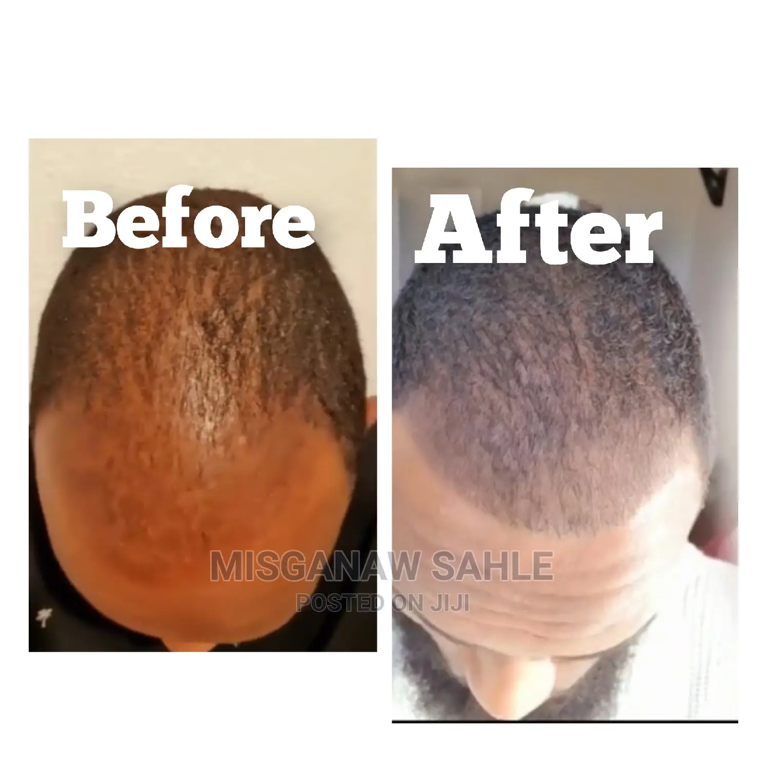 ኒዮ ፀጉር ሎሽን 100% ኦሪጅናል ከነጻ የማድረስ አገልግሎት ጋር እና ደርማ ሮለር - Neo