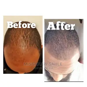 ኒዮ ፀጉር ሎሽን 100% ኦሪጅናል ከነጻ የማድረስ አገልግሎት ጋር እና ደርማ ሮለር - Neo