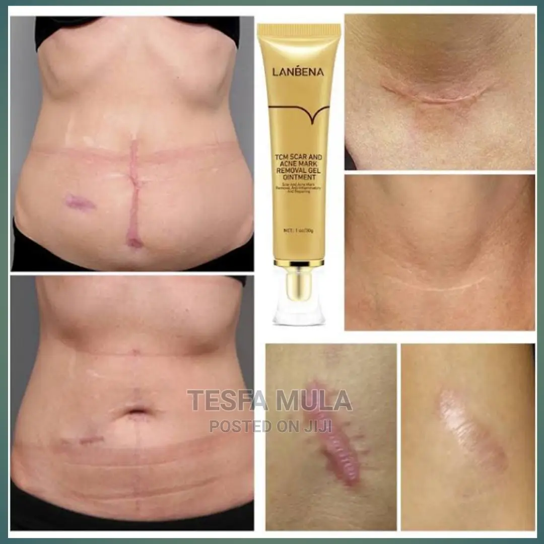 Lanbena ጠባሳ ያስለቅቃል