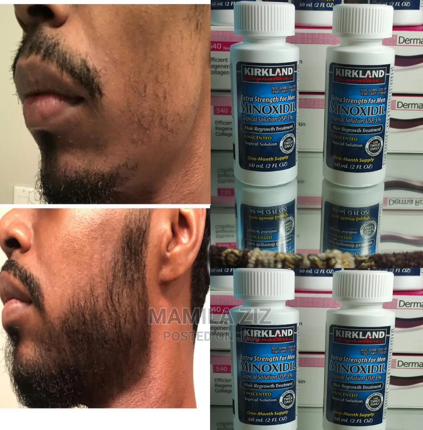 Minoxidil 5%