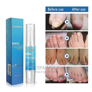 Photo - በፈንገስ በአደጋ ለተላሸ ጥፍር ያስተካክላል