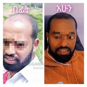 ኒዮ NEO HAIR LOTION And Derma Roller