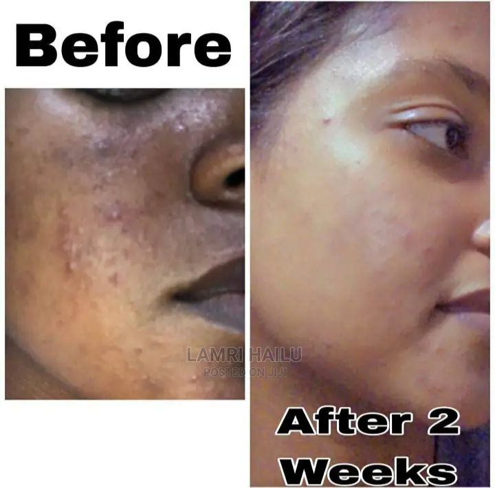 Albent Healing , Face Mask