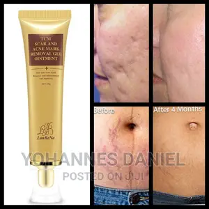 Photo - TCM Scar Removal