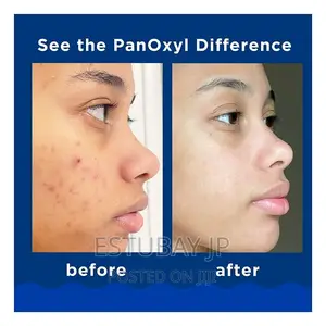 Panoxyl Ance Foaming Wash