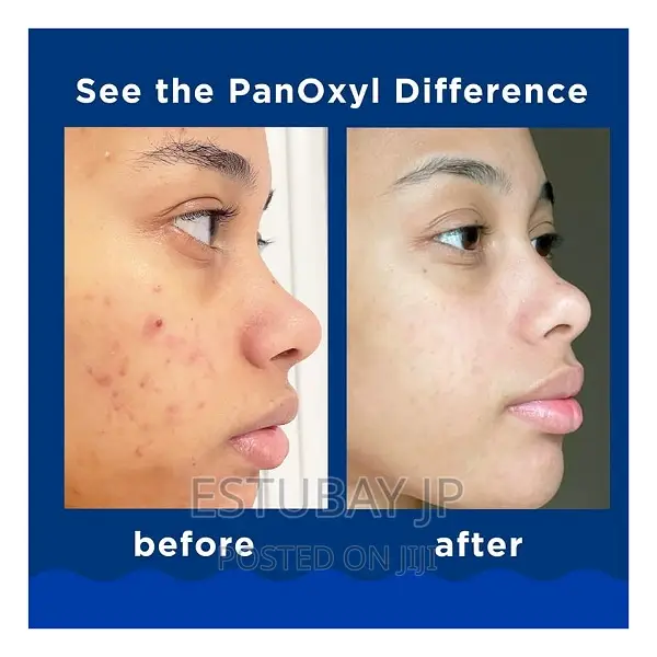 Panoxyl Ance Foaming Wash