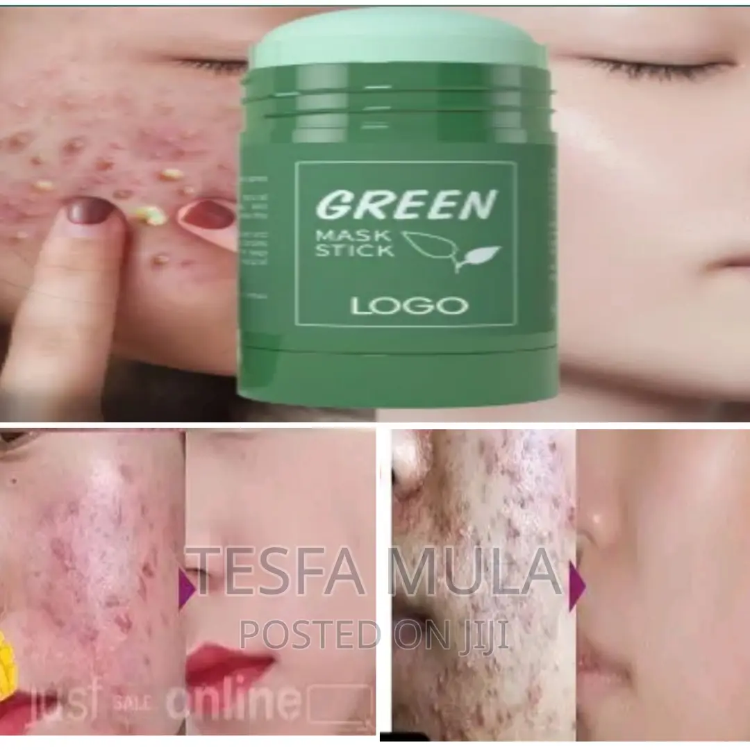 Maks ፊት ላይ ብጉር ማድያት ያጠፋል