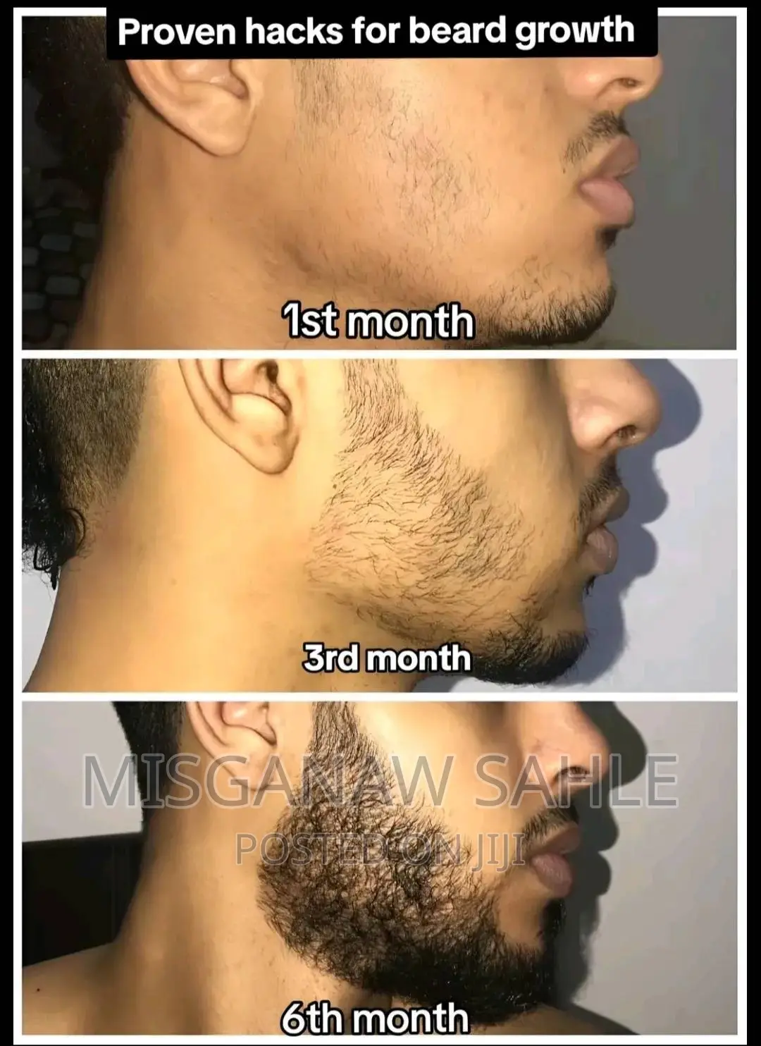 Minoxidil እና Dermaroller