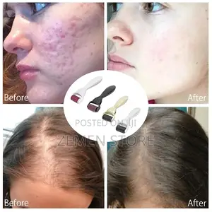 Photo - 4 in 1 Derma Roller ለተመለጠ ፀጉር ፂም ለማሳደግ ለተበላሸ የፊትቆዳ ሁነኛ መፍትሄ