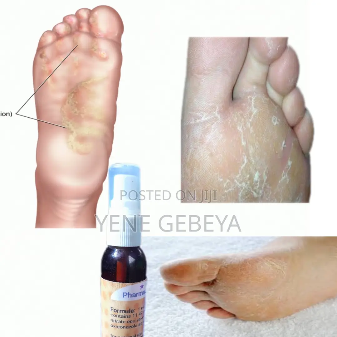 የእግር ፈንገስ ማጥፊያ