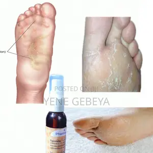 Photo - የእግር ፈንገስ ማጥፊያ