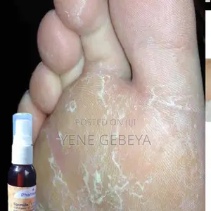 Photo - የእግር ሽታና ላብን በዘላቂነት ማጥፊያ