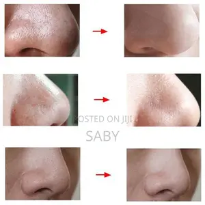 Facial Cleaner and Blackhead