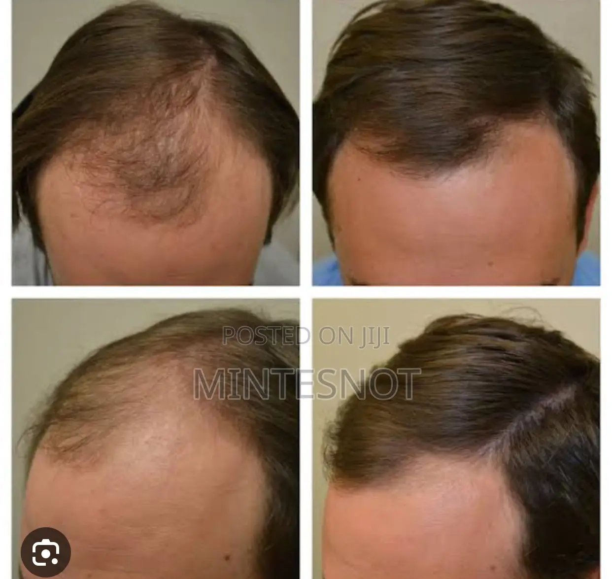 Kirkiland Minoxidil