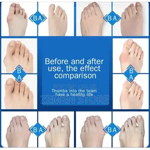 Hallux Valgus Corrector Bunions for Toes