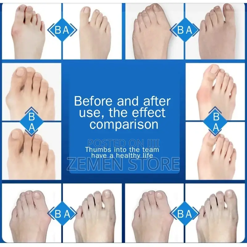 Hallux Valgus Corrector Bunions for Toes