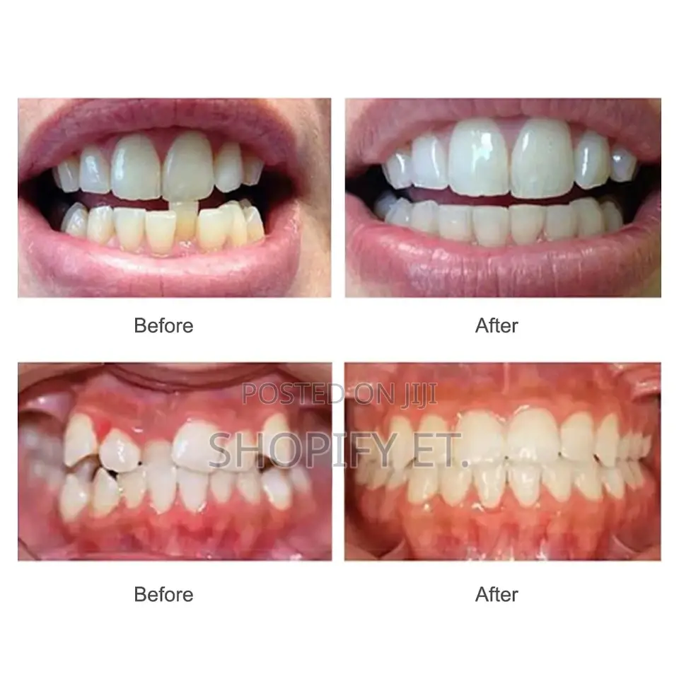 3 Piece Teeth Alignment ( Full Set)