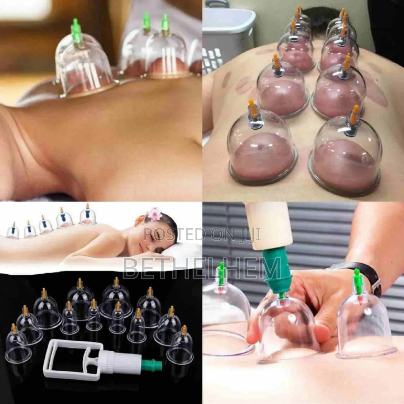 Traditional Cupping Terapy