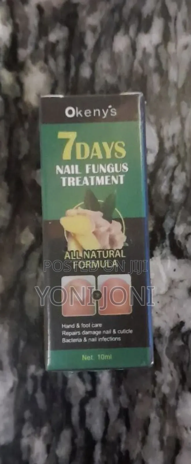 Nail Fungus Treatment, Tefere Metmet Yemiyatefa